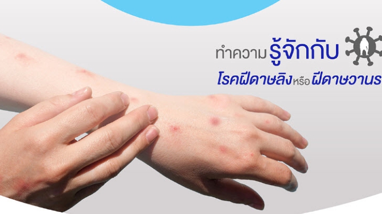 โรคฝีดาษลิง หรือ MONKEYPOX โรคระบาดใหม่ที่ไม่ควรมองข้าม